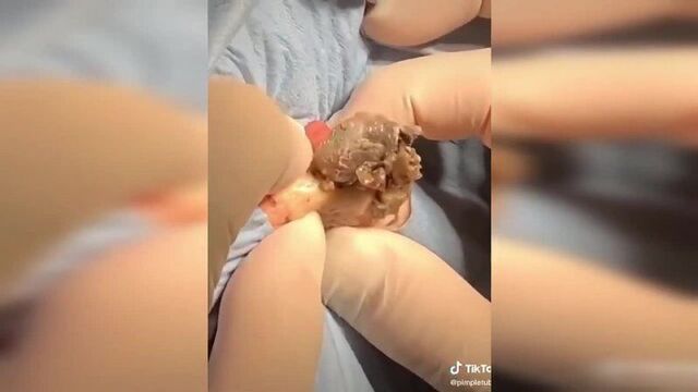Pimple squeezing compilation I pimple squeezing